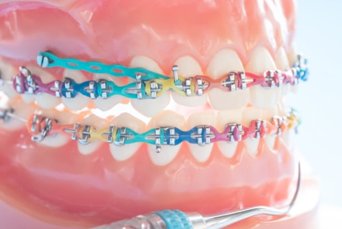 Rubber Bands Or Orthodontic Elastics – Do I Really Need Them? Austin  Orthodontist Explains
