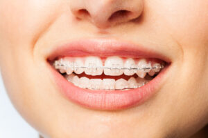 Clear Braces for Teens and Adults in Buffalo, NY | Free Consult