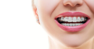 Braces Alternatives in Buffalo, NY | Book a Free Consultation