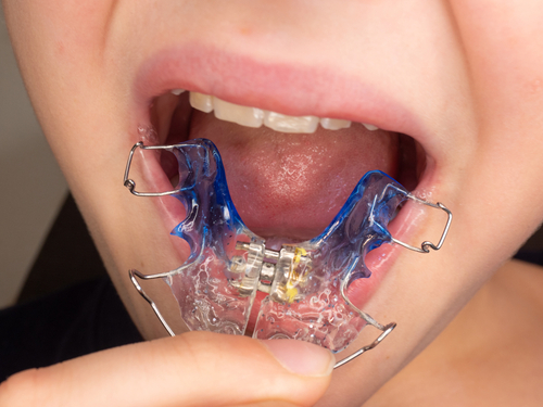 Retainers in Buffalo, NY | Removable vs. Permanent Retainers