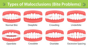 Normal Bite Evaluation in Buffalo, NY | Book a Free Consultation